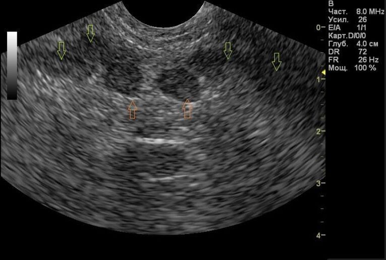 prostatitis na mojim rezultatima ultrazvuka